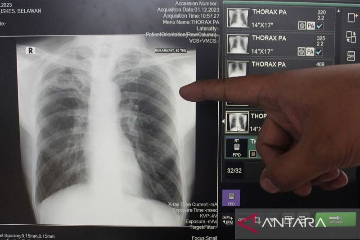 Dokter rehab medik sarankan latihan batuk efektif saat pemulihan TBC